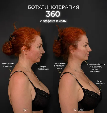 Коррекция линии плеч, до и после