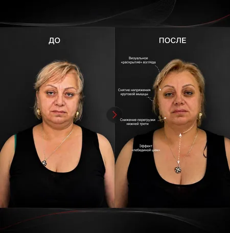 Коррекция нижней трети лица, до и после